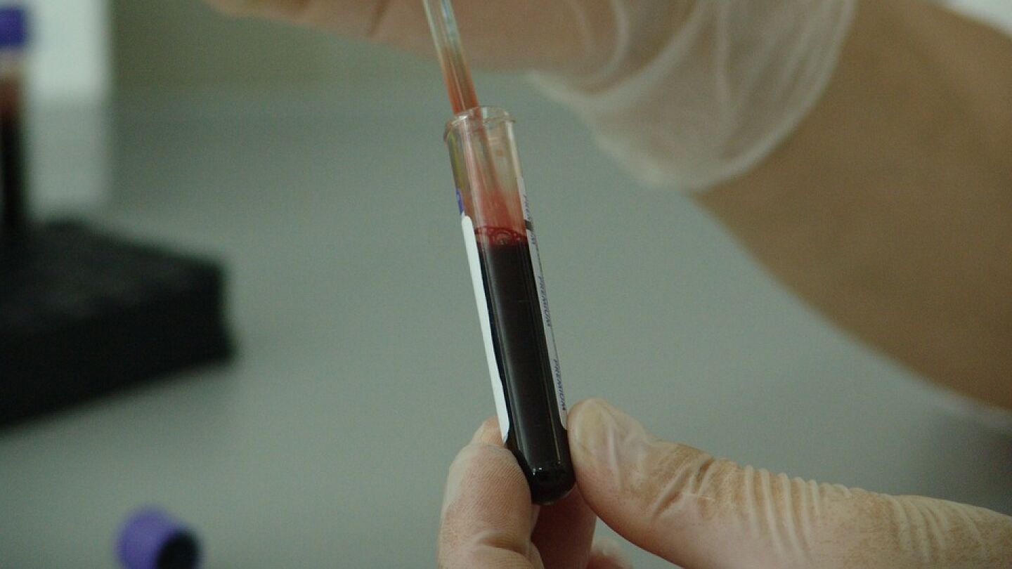 Un an&aacute;lisis de sangre permitir&iacute;a detectar si tienes c&aacute;ncer de p&aacute;ncreas y pancreatitis
