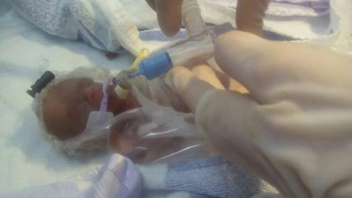 Un bebé prematuro del tamaño de una pelota de tenis consigue sobrevivir Un bebé prematuro del tamaño de una pelota de tenis consigue sobrevivir