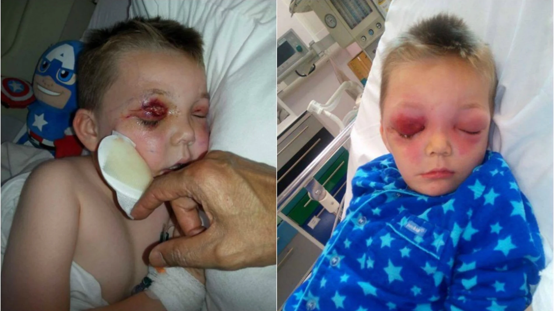 El niño ingresado en el hospital por la picadura de un insecto en el ojo