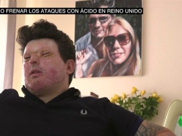 Andreas Christopheros víctima de un ataque con ácido Andreas Christopheros víctima de un ataque con ácido