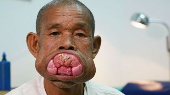 Eng Kheng antes de la operaci&oacute;n del tumor