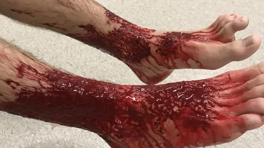 Los pies de Sam Kanizay tras el ataque de las criaturas Los pies de Sam Kanizay tras el ataque de las criaturas