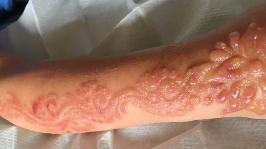 Marcas que dejó el tatuaje de henna Marcas que dejó el tatuaje de henna