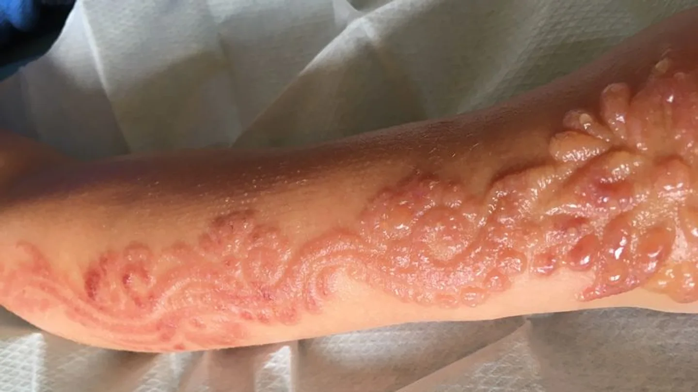 Marcas que dejó el tatuaje de henna Marcas que dejó el tatuaje de henna