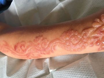 Marcas que dejó el tatuaje de henna Marcas que dejó el tatuaje de henna