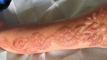 Marcas que dejó el tatuaje de henna