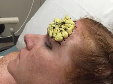 Melanoma desmoplásico Melanoma desmoplásico