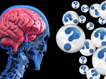 Alzheimer Alzheimer