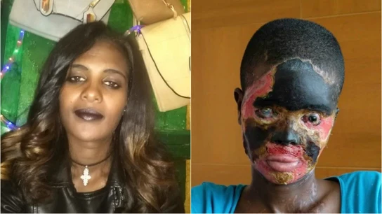 Atsede antes y después del ataque de ácido Atsede antes y después del ataque de ácido