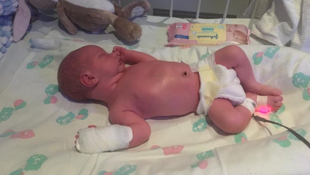 Porque da meningitis bebes