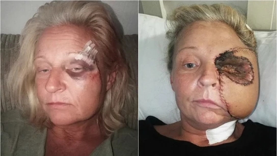 Donna Corden, antes y después de su primera reconstrucción de cara Donna Corden, antes y después de su primera reconstrucción de cara
