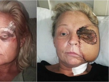 Donna Corden, antes y después de su primera reconstrucción de cara Donna Corden, antes y después de su primera reconstrucción de cara