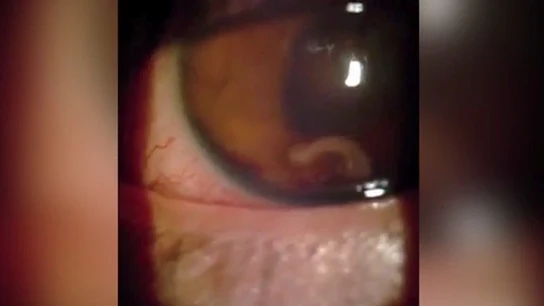 El joven con el gusano parásito en el ojo El joven con el gusano parásito en el ojo
