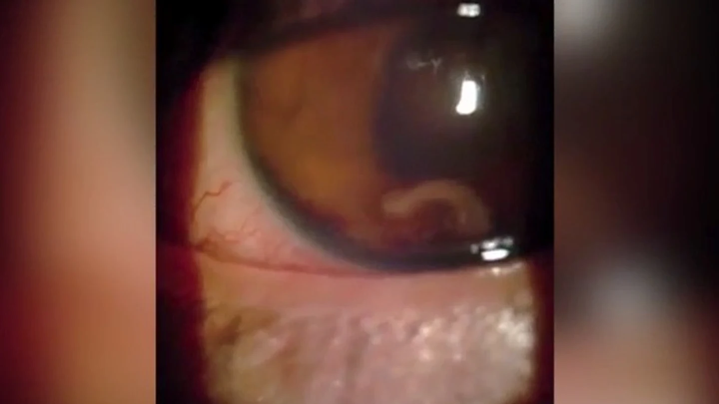 El joven con el gusano parásito en el ojo El joven con el gusano parásito en el ojo