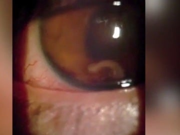 El joven con el gusano parásito en el ojo El joven con el gusano parásito en el ojo