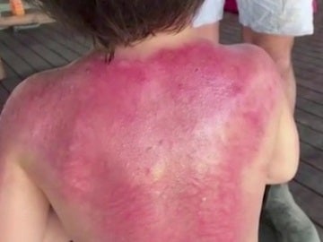 Quemaduras Quemaduras