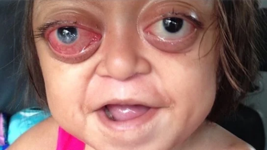 Anabelle sufre el 'Síndrome de Crouzon', una rara enfermedad genética Anabelle sufre el 'Síndrome de Crouzon', una rara enfermedad genética