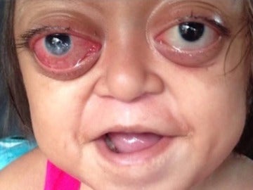 Anabelle sufre el 'Síndrome de Crouzon', una rara enfermedad genética Anabelle sufre el 'Síndrome de Crouzon', una rara enfermedad genética