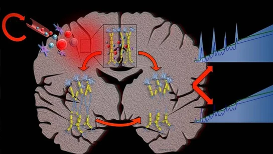 La computacion confirma el grave pronostico de la esclerosis multiple La computacion confirma el grave pronostico de la esclerosis multiple