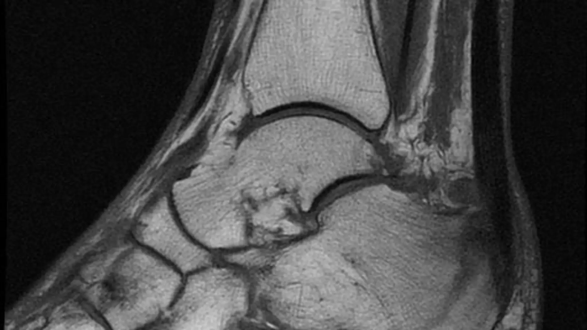 Un software reconstruye fracturas oseas en 3D para facilitar las cirugias