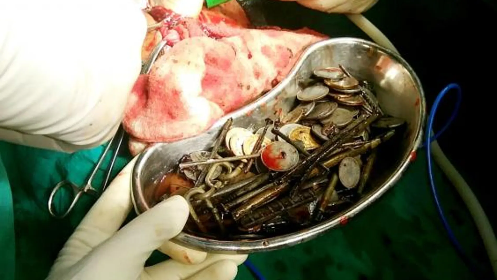 Cientos de objetos de metales extraídos del estómago del paciente