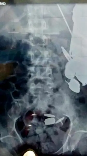 Una radiografía del paciente Una radiografía del paciente