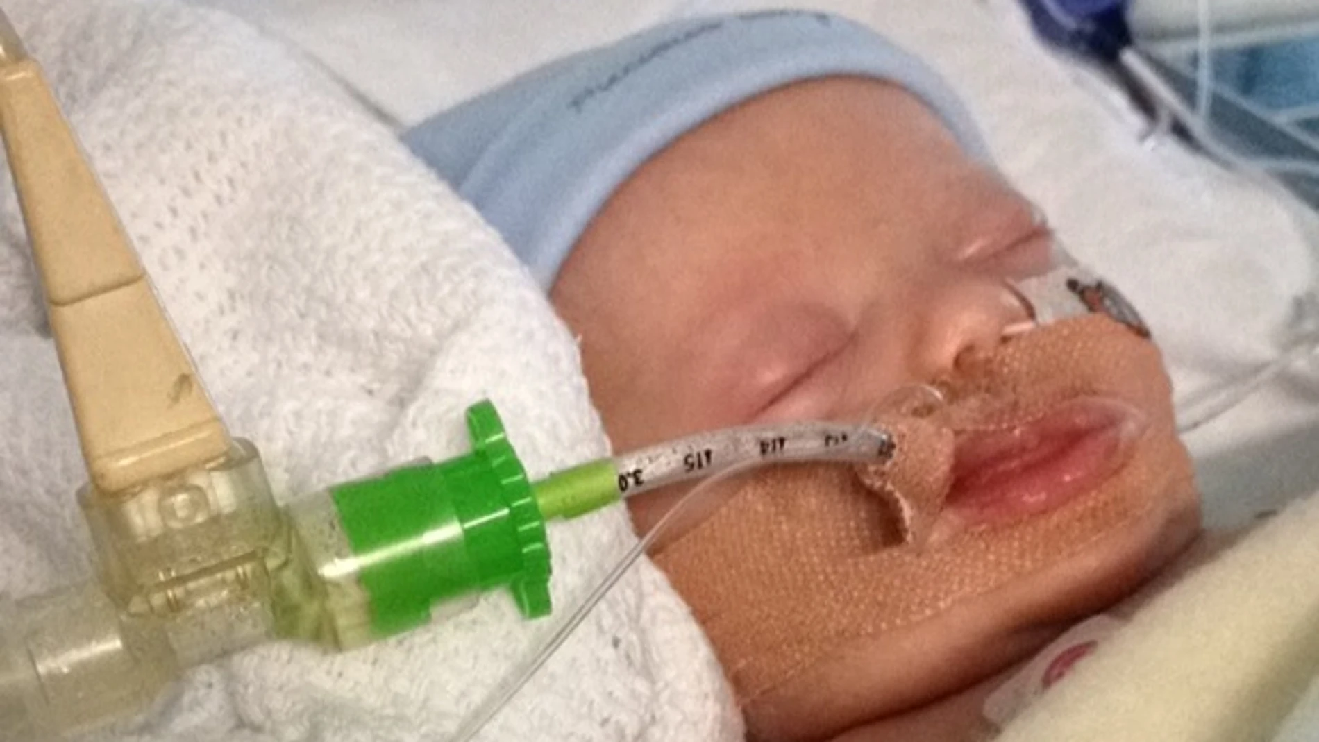 El bebé enfermo de bronquitis en el hospital con un ventilador