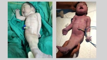 El segundo bebé con sindromelia del mundo ha muerto cuatro horas después de nacer