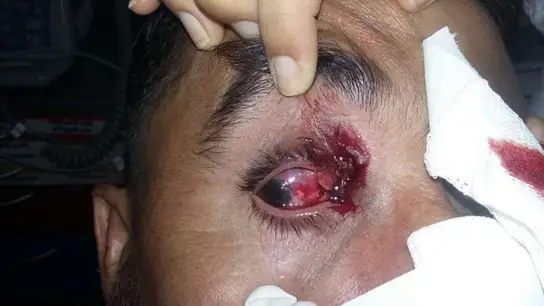 Así quedó el ojo de uno de los jugadores Así quedó el ojo de uno de los jugadores