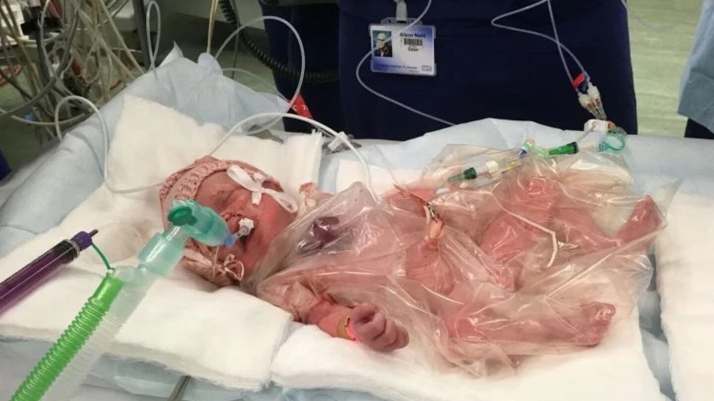 Vanellope Hope, la beb&eacute; que naci&oacute; con el coraz&oacute;n fuera del pecho