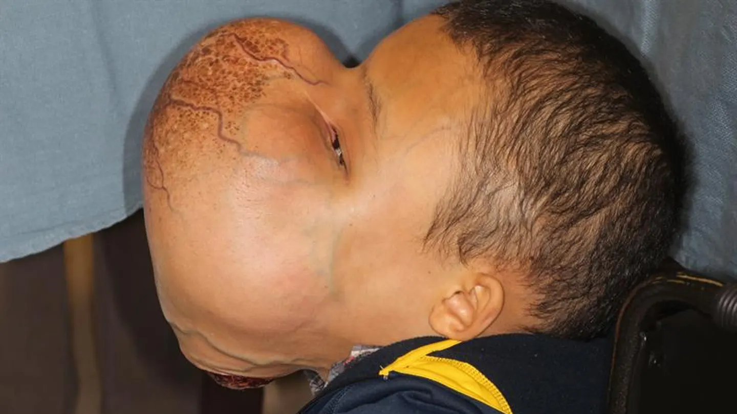 El niño con el tumor facial El niño con el tumor facial