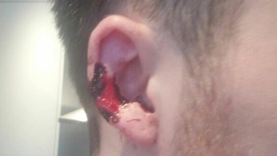 As&iacute; qued&oacute; la oreja de la v&iacute;ctima tras el mordisco