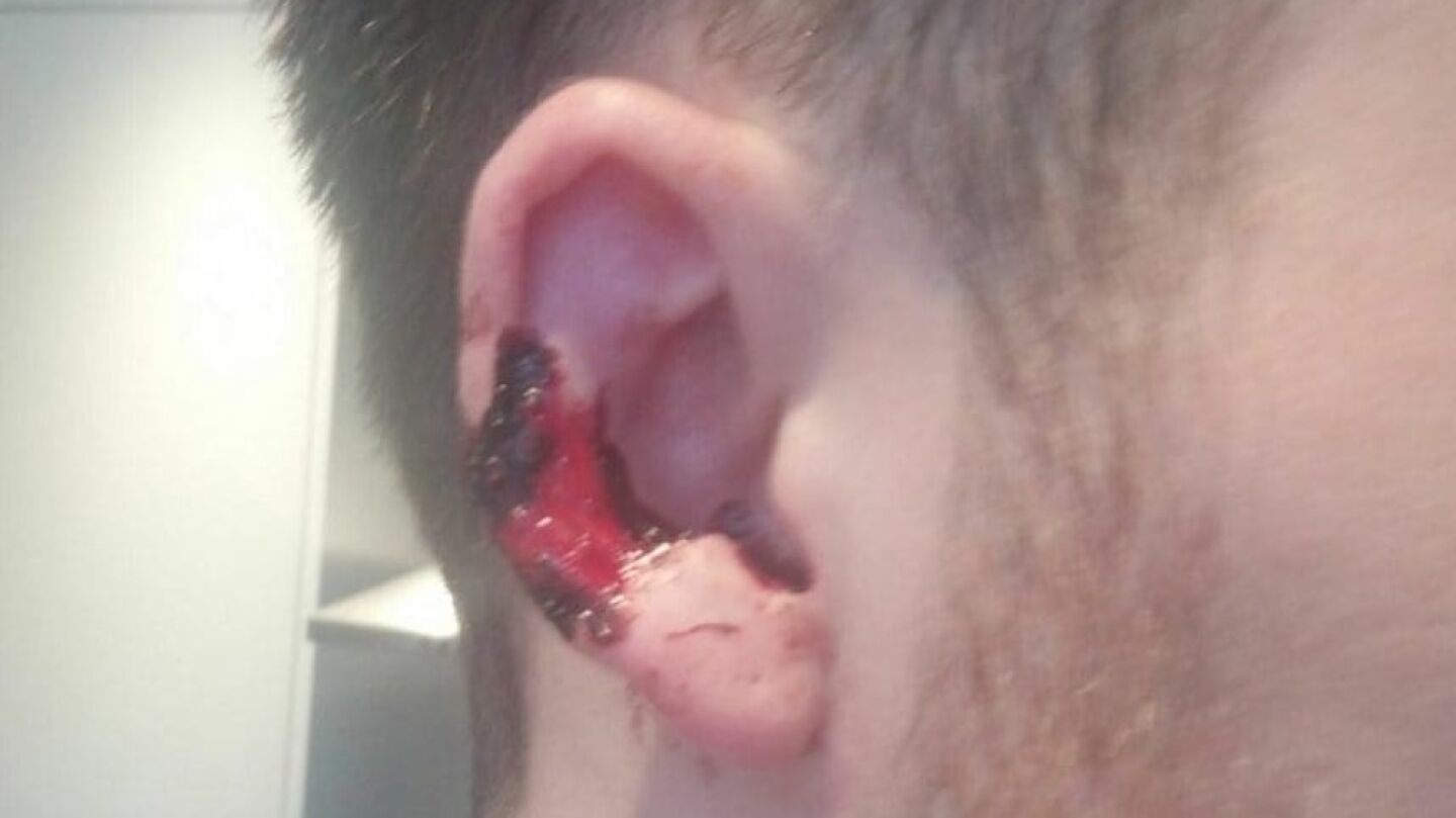 As&iacute; qued&oacute; la oreja de la v&iacute;ctima tras el mordisco