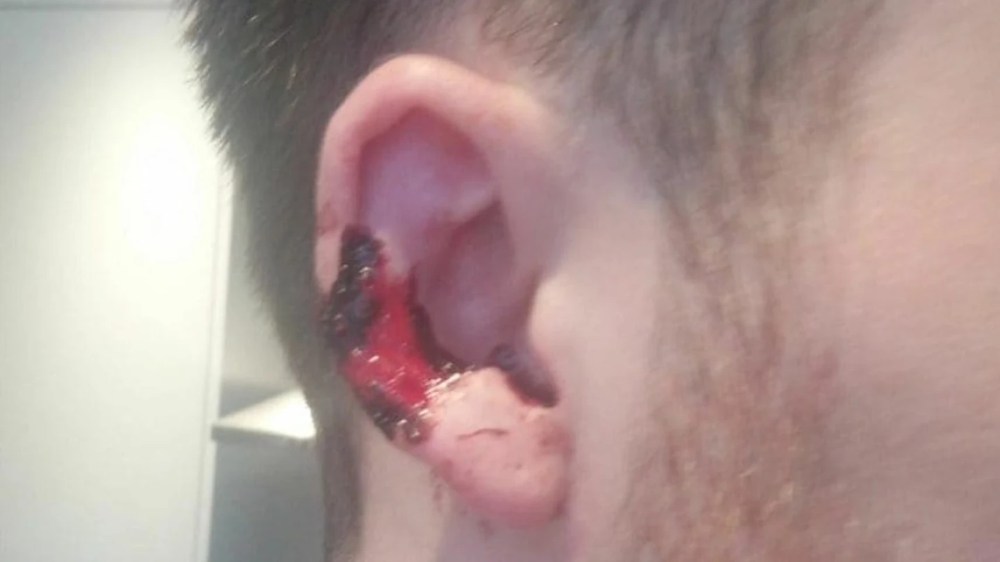 Así quedó la oreja de la víctima tras el mordisco Así quedó la oreja de la víctima tras el mordisco