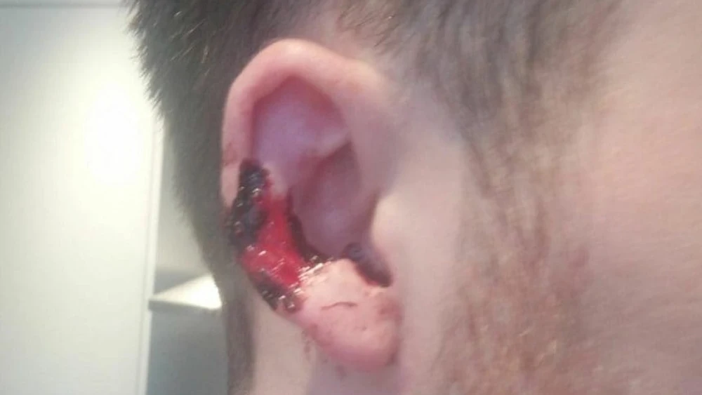 Así quedó la oreja de la víctima tras el mordisco