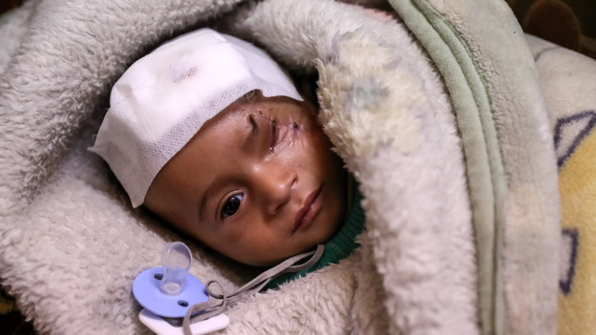 Karim, un niño herido en un bombardeo al este de Al-Guta