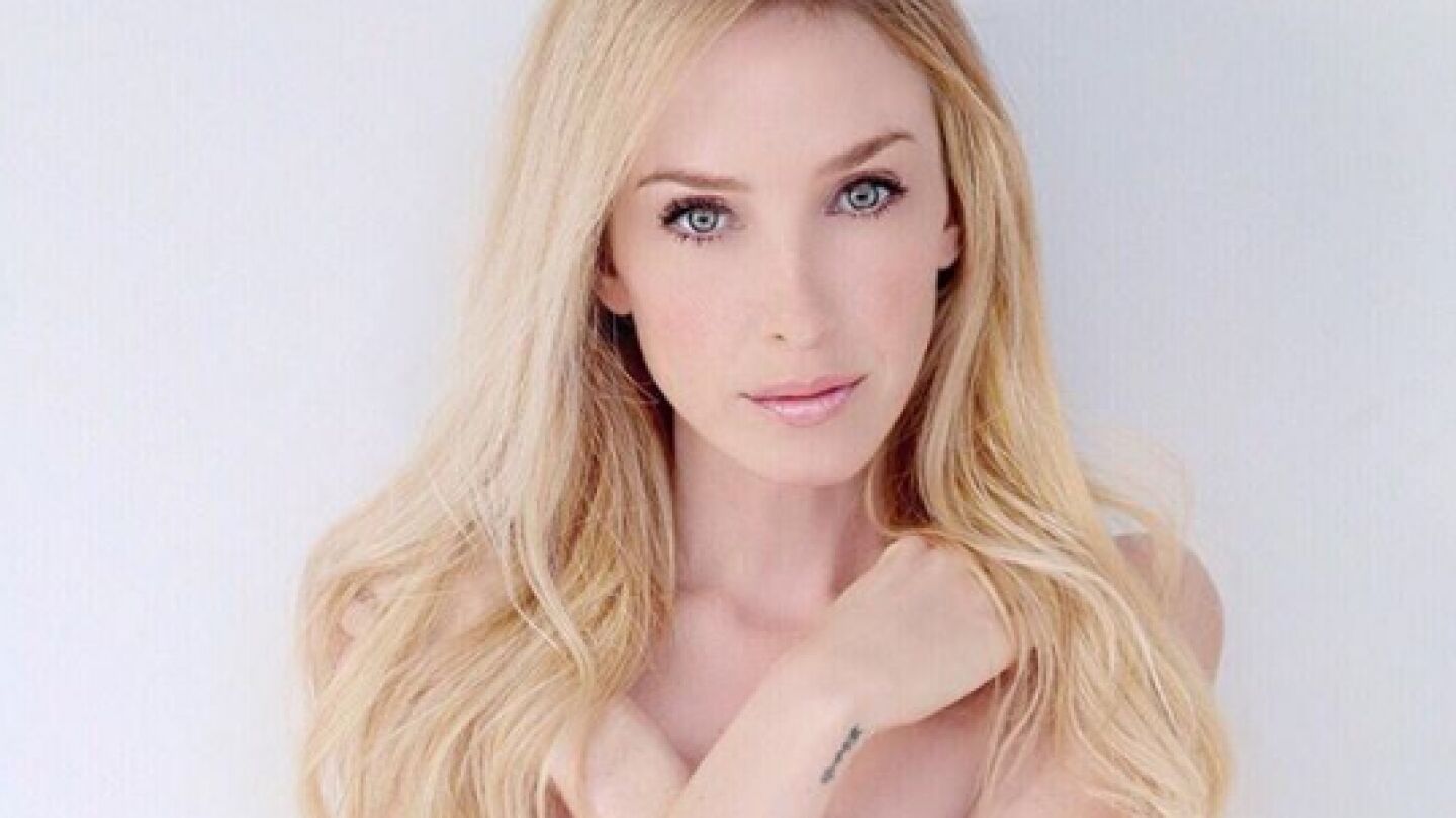 La joven Taylor Muhl que padece quimerismo