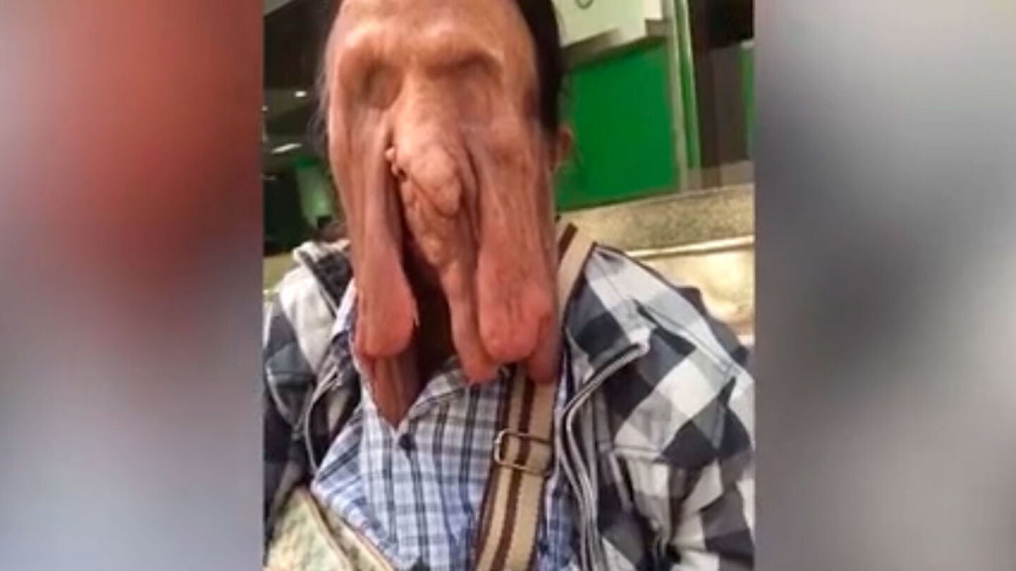 Wiang Boonmee padece una enfermedad rara en la cara