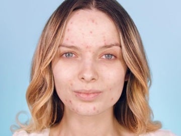 Un grupo de mujeres publica fotos sin maquillaje para normalizar el acné