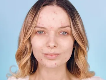 Un grupo de mujeres publica fotos sin maquillaje para normalizar el acné Un grupo de mujeres publica fotos sin maquillaje para normalizar el acné
