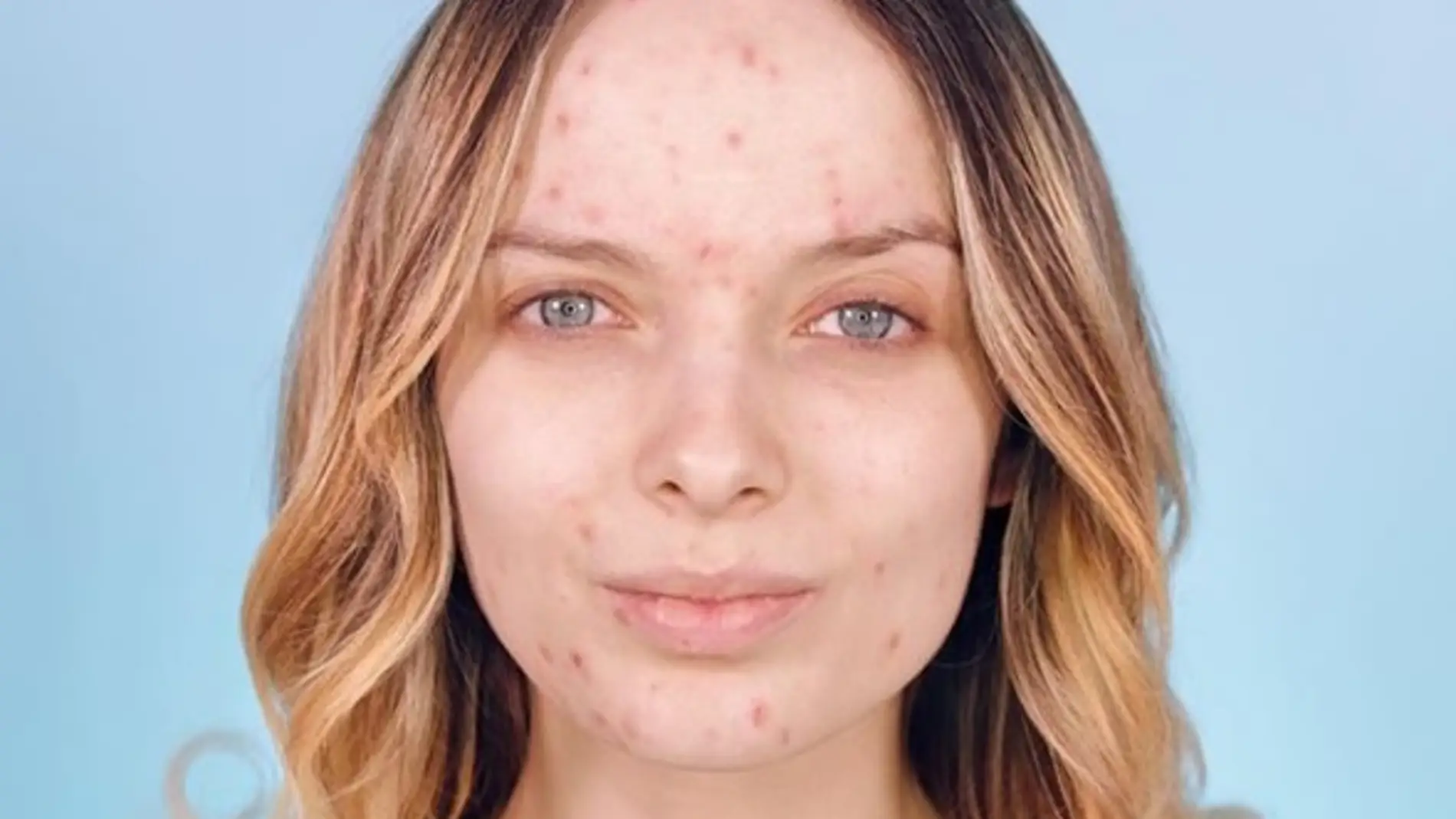 Un grupo de mujeres publica fotos sin maquillaje para normalizar el acné