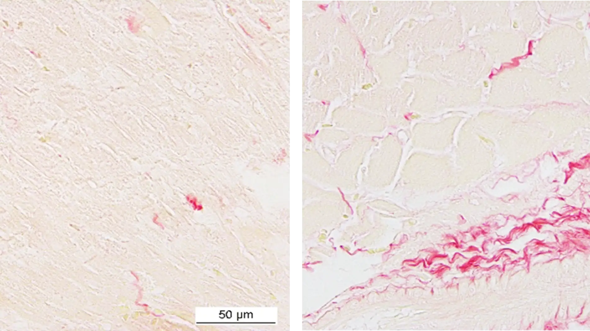 Nuevos datos sobre el desarrollo de fibrosis cardiaca en la obesidad