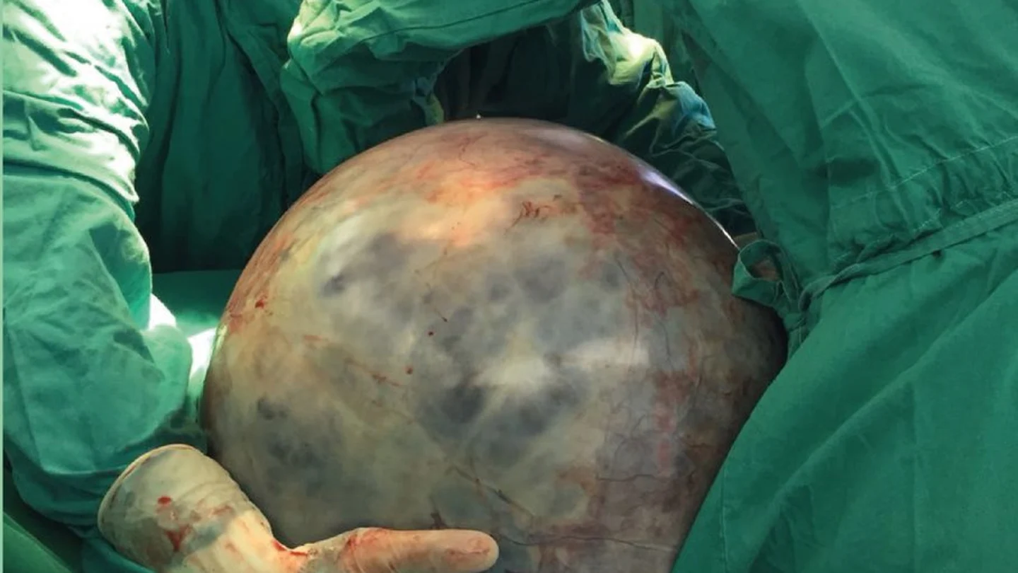 El tumor de 34 kilos El tumor de 34 kilos