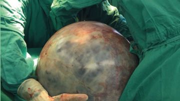 El tumor de 34 kilos