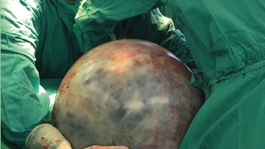 El tumor de 34 kilos