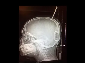 Radiografía que muestra la perforación del cráneo Radiografía que muestra la perforación del cráneo