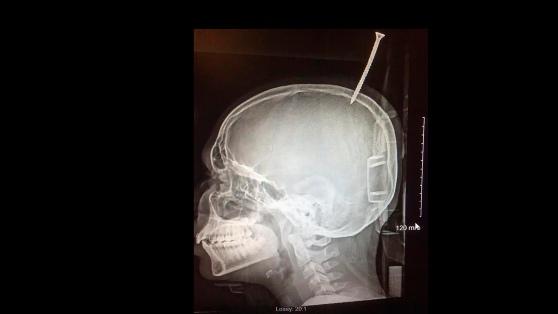 Radiografía que muestra la perforación del cráneo