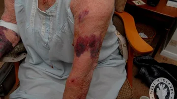 Las heridas que provocó el agresor en la anciana