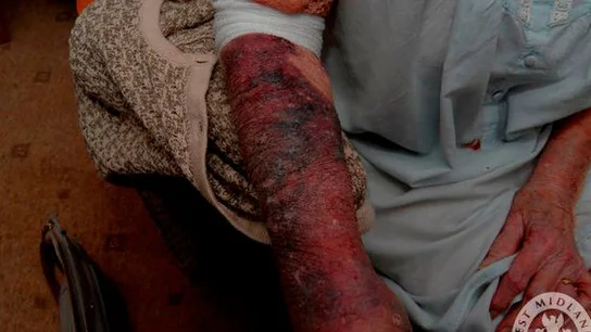 Las heridas que provocó el agresor en la anciana Las heridas que provocó el agresor en la anciana