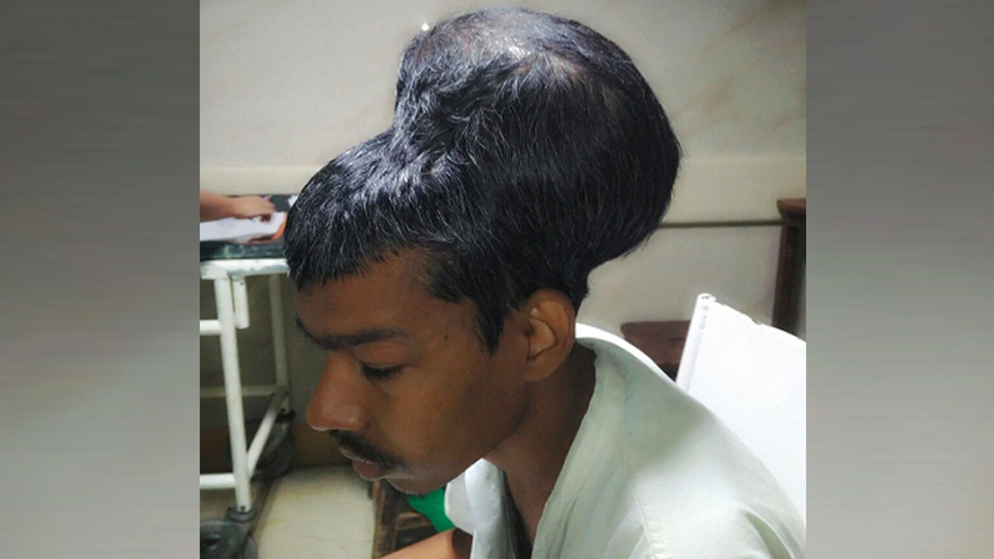 Imagen del hombre operado en La India de un tumor de casi dos kilos Imagen del hombre operado en La India de un tumor de casi dos kilos